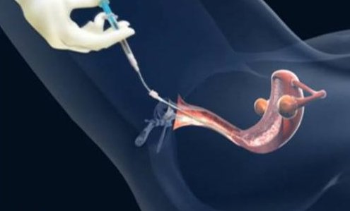 抚顺做第三代试管婴儿费用是多少钱，哪医院做？